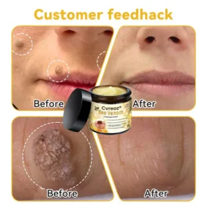 🌟 Official Store | Cvreoz® Bee Venom Skin Treatment Cream🚀LAST DAY 80% OFF(Sagging Skin, Fine Lines, Loss of Firmness, Flat Bust, Drooping Hips, and More)