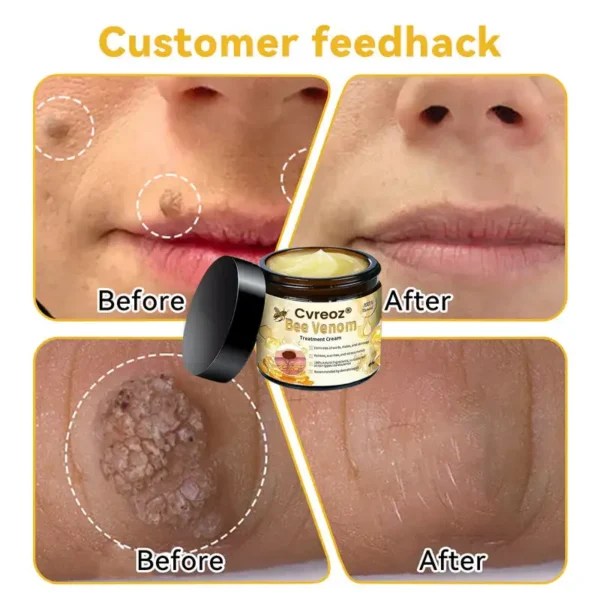 🌟 Official Store | Cvreoz® Bee Venom Skin Treatment Cream🚀LAST DAY 80% OFF(Sagging Skin, Fine Lines, Loss of Firmness, Flat Bust, Drooping Hips, and More)