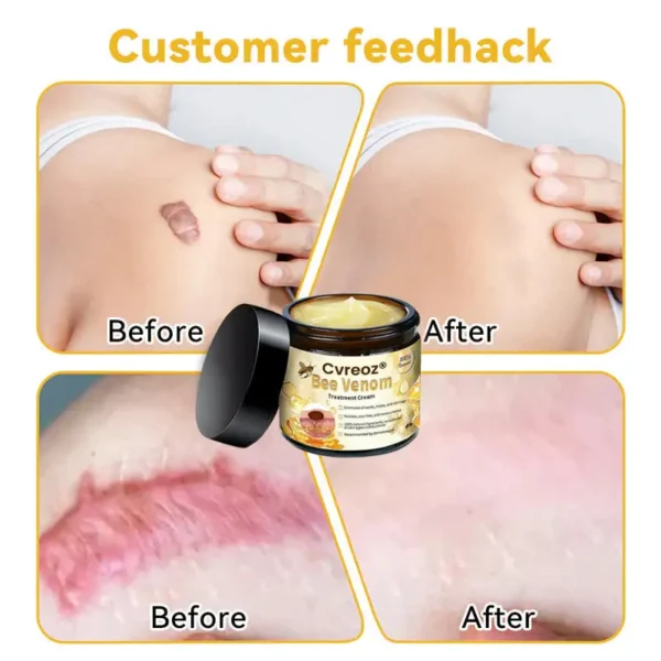 🌟 Official Store | Cvreoz® Bee Venom Skin Treatment Cream🚀LAST DAY 80% OFF(Sagging Skin, Fine Lines, Loss of Firmness, Flat Bust, Drooping Hips, and More)