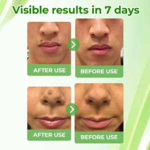 🔥HOT SALE: 60% OFF🔥Cvreoz® Natural Spot and Mole removal cream