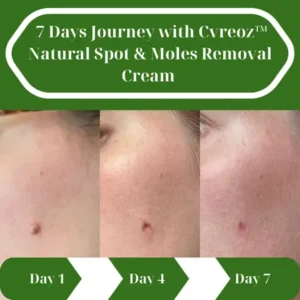 🔥HOT SALE: 60% OFF🔥Cvreoz® Natural Spot and Mole removal cream