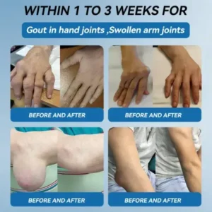 𝐟𝐥𝐲𝐬𝐦𝐮𝐬® 𝐁𝐏𝐂-𝟏𝟓𝟕 𝐉𝐨𝐢𝐧𝐭 𝐇𝐞𝐚𝐥𝐢𝐧𝐠 𝐂𝐫𝐞𝐚𝐦