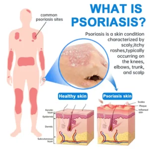 ✅ Official Store: QIAWI   Magnesium Herbal Psoriasis Spray 👨‍⚕️ MHRA Approved (Relieves psoriasis and eczema, improves bacterial infections in the genital area, treats acne and warts)