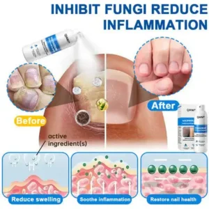 ✅ Official Store: QIAWI   Magnesium Herbal Psoriasis Spray 👨‍⚕️ MHRA Approved (Relieves psoriasis and eczema, improves bacterial infections in the genital area, treats acne and warts)