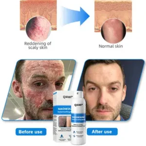 ✅ Official Store: QIAWI   Magnesium Herbal Psoriasis Spray 👨‍⚕️ MHRA Approved (Relieves psoriasis and eczema, improves bacterial infections in the genital area, treats acne and warts)