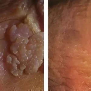 Alisanda™ |Genital Warts Remover Cream for Men