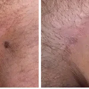 Alisanda™ |Genital Warts Remover Cream for Men