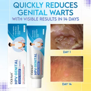 ✨ODEIUN™ HPV Genital Warts Relief Cream – Fast, Gentle & Private Care💪