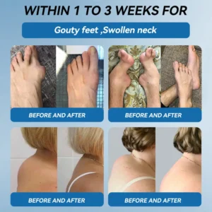 | 𝐋𝐚𝐬𝐭 𝐃𝐚𝐲 𝐏𝐫𝐨𝐦𝐨𝐭𝐢𝐨𝐧 𝟖𝟎% 𝐎𝐅𝐅 |  🇨🇦 Croaie® ʙ.ᴘ.ᴄ-157 Joint Healing Cream🦴Treats Arthritis, Neuropathy, Rheumatism, Sports Injuries & More🌸🌸