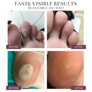 Alisanda® BlackRice Nano Clear Wart Repair Cream