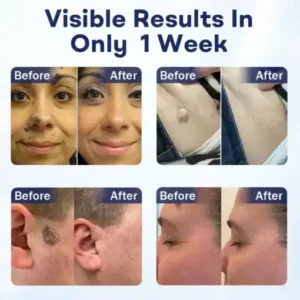 Cvreoz® Mole and Wart Removal Cream