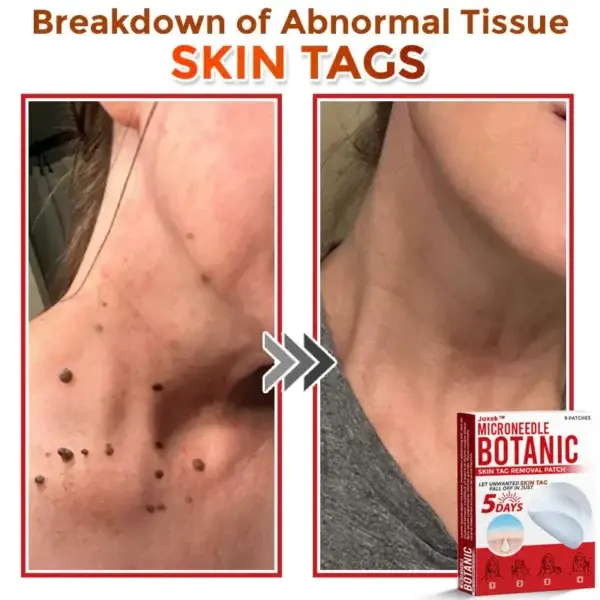 Juxekdd324™ Removal Patch: Gentle Microneedle Patches for Skin Tag & Mole Removal (Copy)