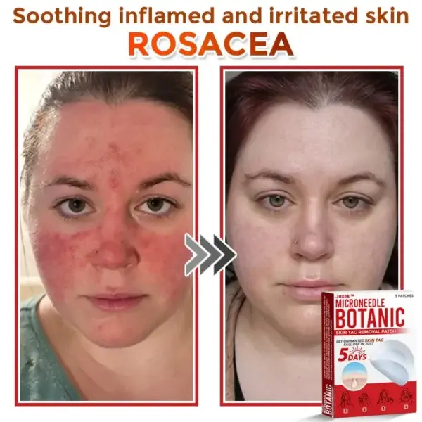 Juxekdd324™ Removal Patch: Gentle Microneedle Patches for Skin Tag & Mole Removal (Copy)