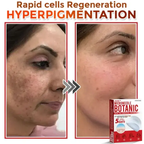 Juxekdd324™ Removal Patch: Gentle Microneedle Patches for Skin Tag & Mole Removal (Copy)