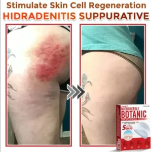 Juxekdd324™ Removal Patch: Gentle Microneedle Patches for Skin Tag & Mole Removal (Copy)