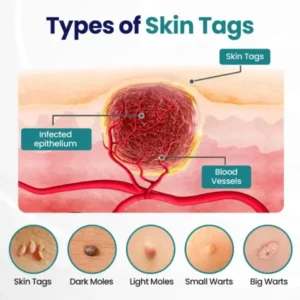 Timilk® WartLift Corn Removal Liquid