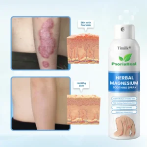 Timilk® PsoriaHeal Herbal Magnesium Soothing Spray