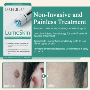 DAFEILA® LumeSkin Mole and Wart Instant Removal Laser Pen ACE 3