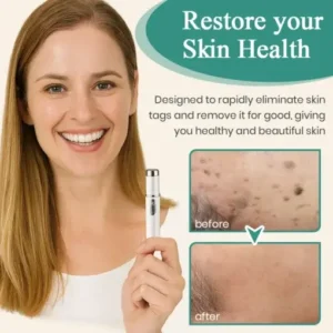 DAFEILA® LumeSkin Mole and Wart Instant Removal Laser Pen ACE 3