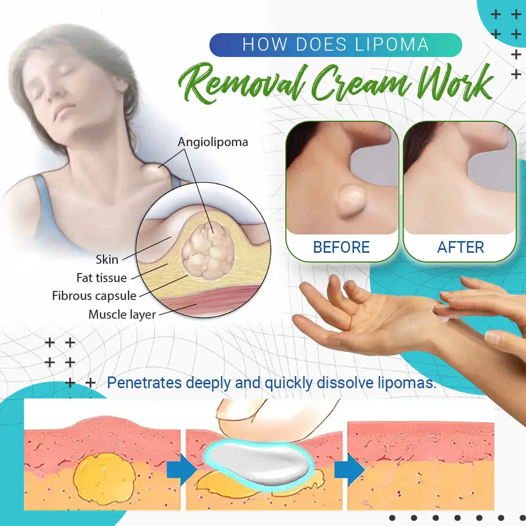 LBMLBM™ Lipoma Removal Cream