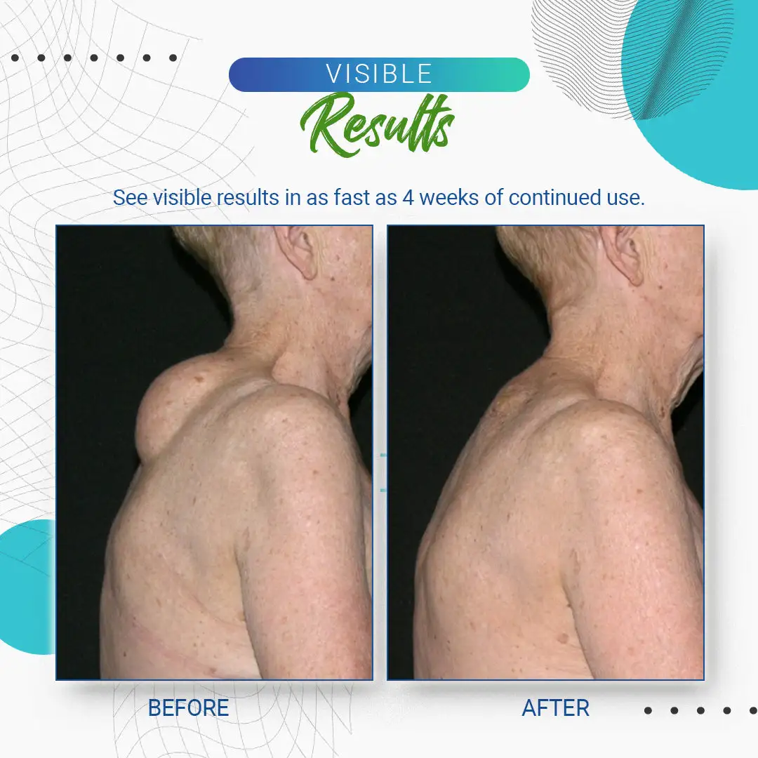 LBMLBM™ Lipoma Removal Cream