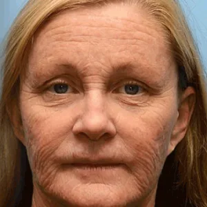 [🔥Last Day 70% OFF]  Juxek™ Botox & Retinol Shot - Eraser for Deep Wrinkles, Sagging Jowls & Puffy Eyes