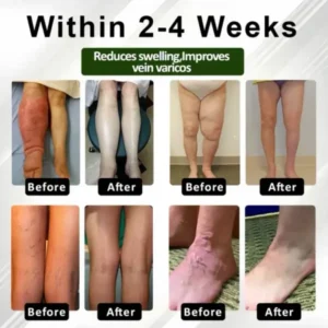 ROSOPL™ Leg Therapy Edema Cream