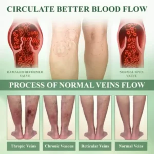 ROSOPL™ Leg Therapy Edema Cream