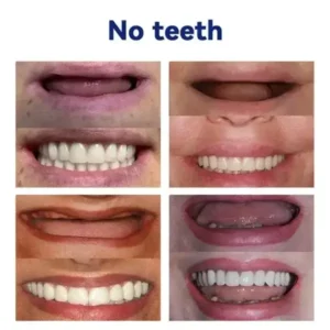 Rosopl™ Ease Dentures