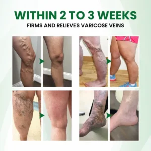 Timilk® VariPoint™ Phyto-Vascular Microneedle Patch